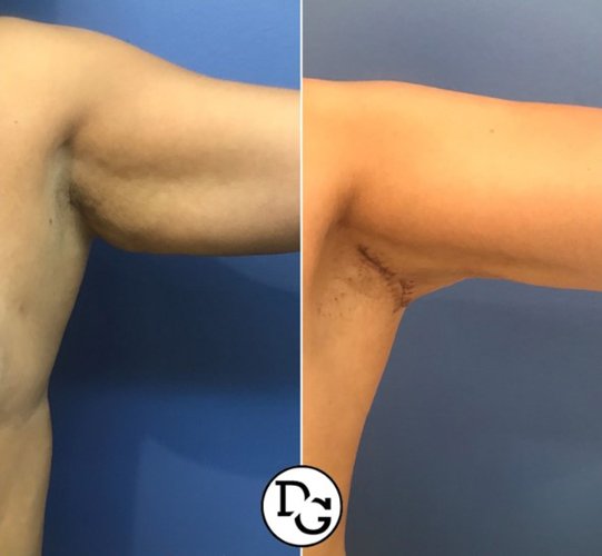 before and after arm lift left arm view of patient