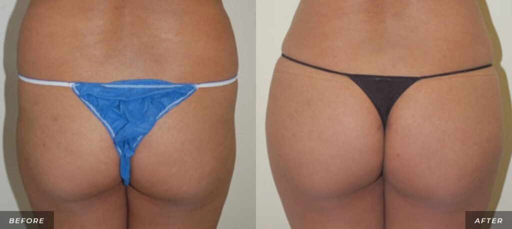 before and after buttock lift left rear view of patient