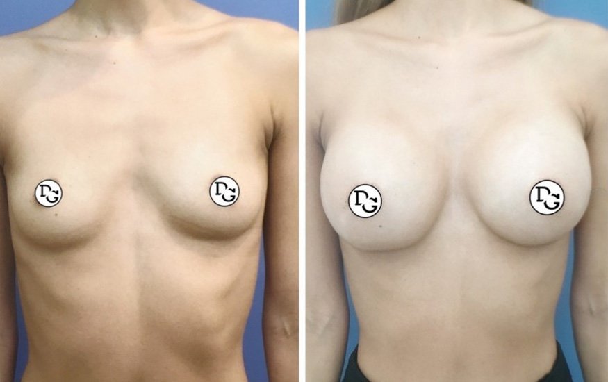 before and after breast augmentation front view of female patient guide