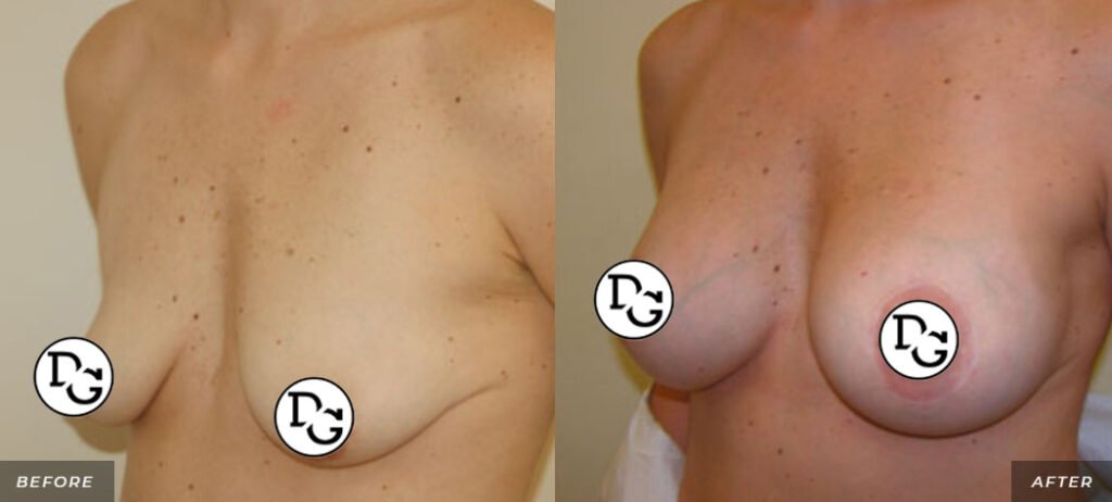 before and after shots breast left left angle view of female patient
