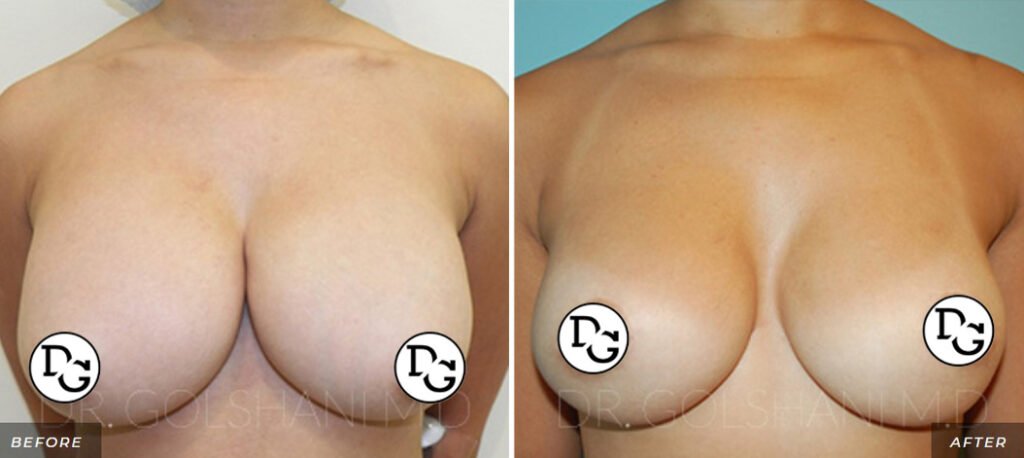 before and after comparison of breast revision front view of female patient