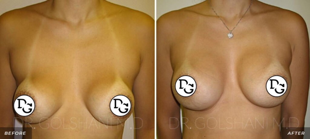 before and after shots breast revision front view of female patient