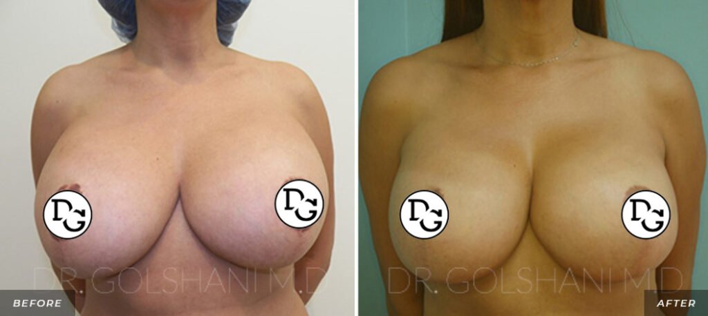 left before and right after comparison breast revision front view of female patient