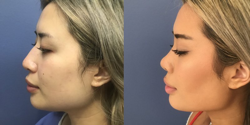 before and after ethnic rhinoplasty shot left side view of female patient