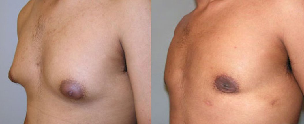 before and after male breast reduction left angle view of male patient 2