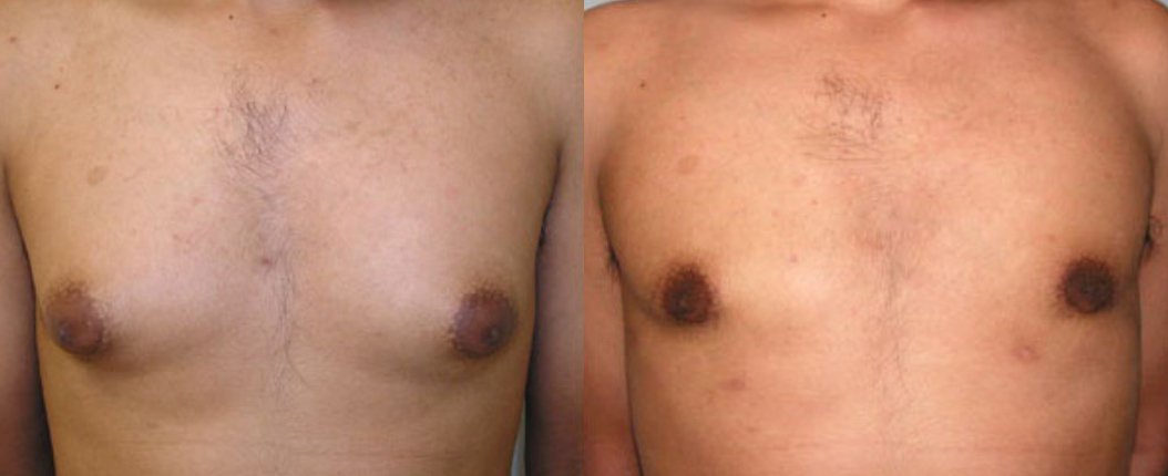 before and after male breast reduction front view of male patient 2