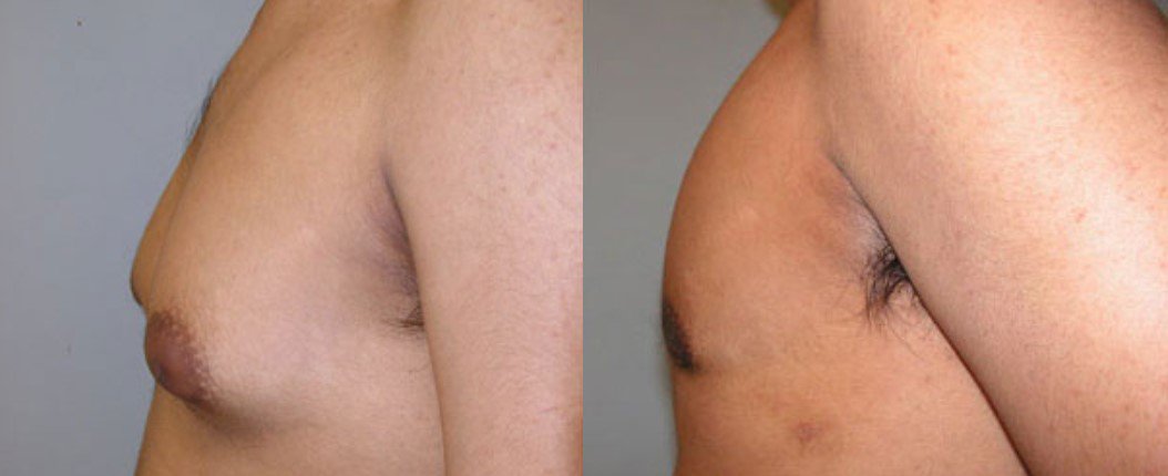 before and after male breast reduction left side view of male patient 2