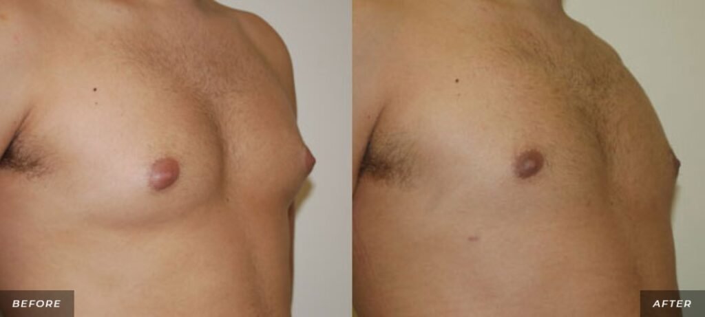 before and after male breast reduction right angle view of male patient 1