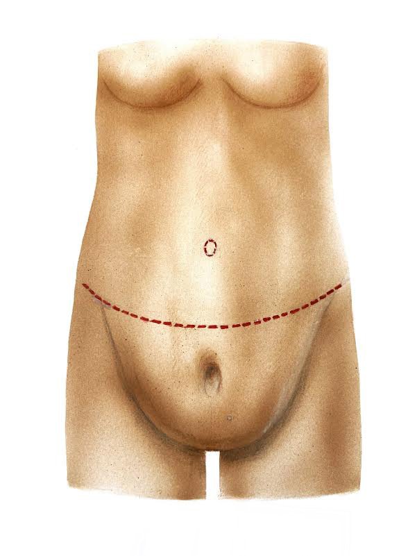 Golshani-Tummy-Tuck-diagram0