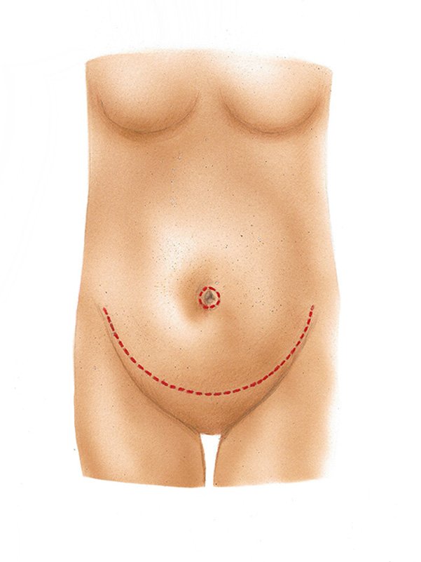 Golshani-Tummy-Tuck-diagram01
