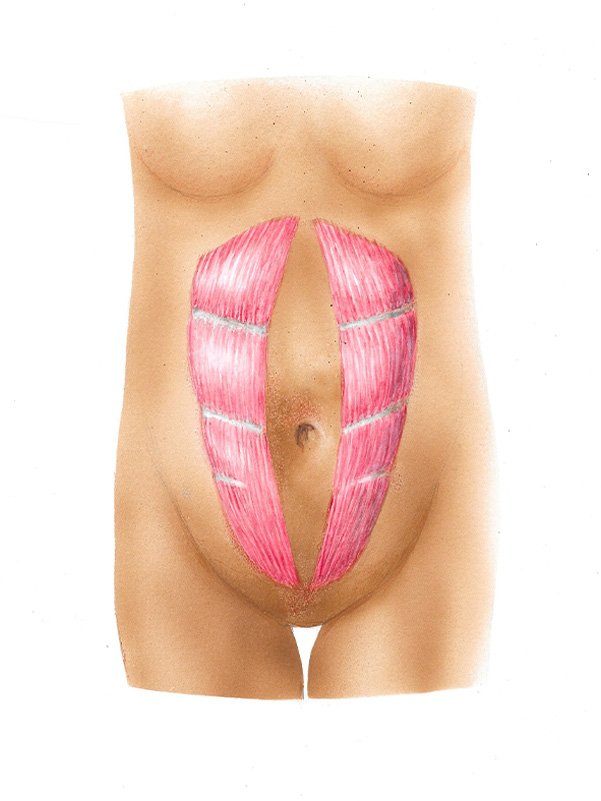 Golshani-Tummy-Tuck-diagram02