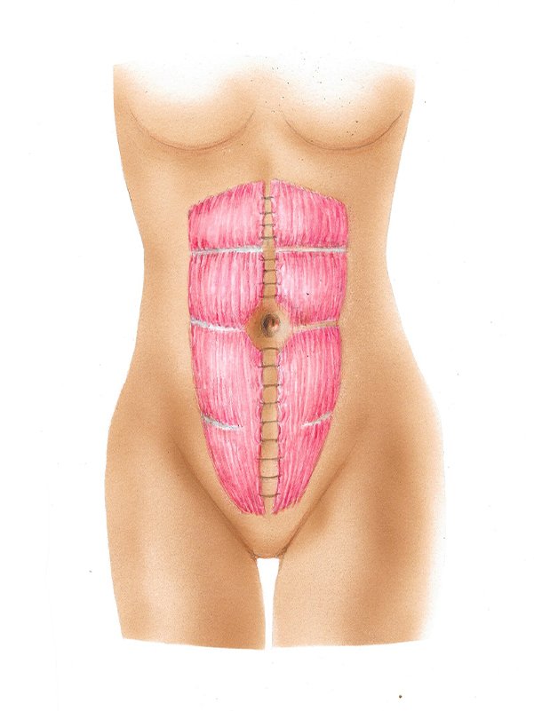 Golshani-Tummy Tuck diagram3