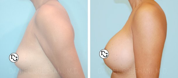 before and after shots breast limplants left side view of female patient
