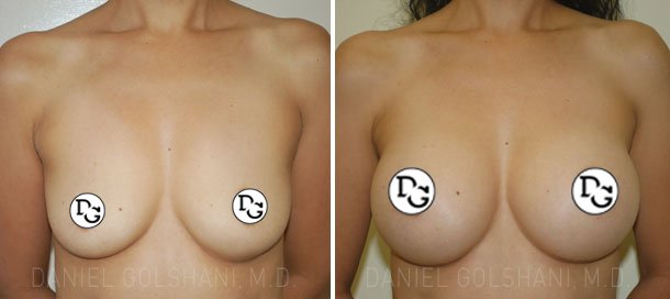 before and after shots breast implants front view of female patient