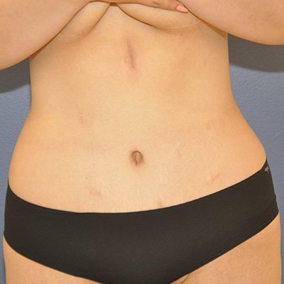 Postop Liposuction