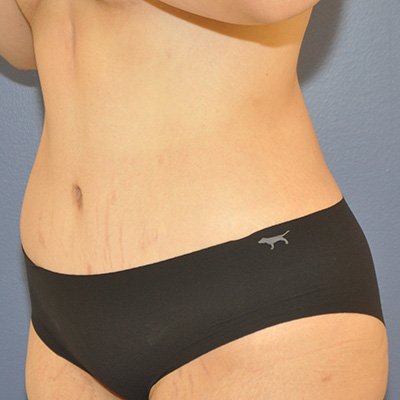 Postop Liposuction