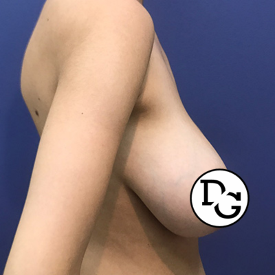Preop Breast Reduction