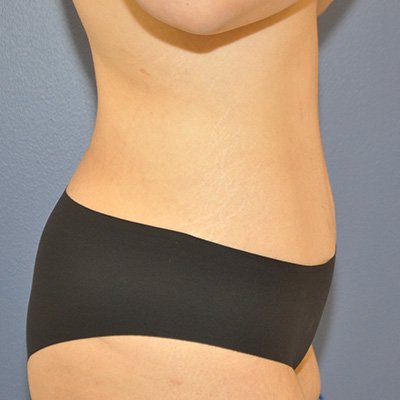 Postop Liposuction