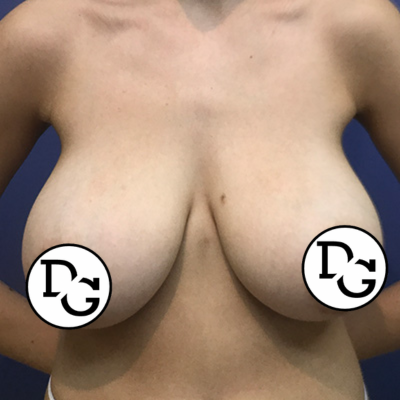 Preop Breast Reduction
