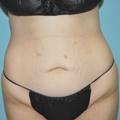 Preop liposuction