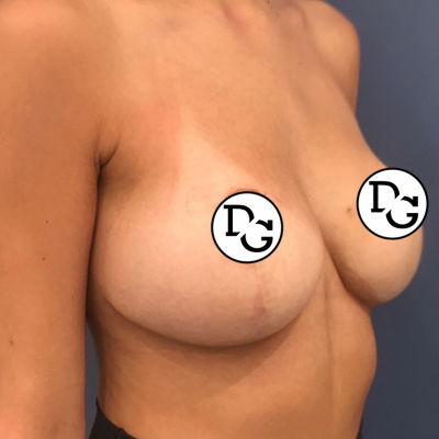 Postop Breast Reduction
