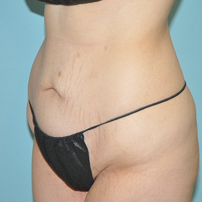 Preop liposuction
