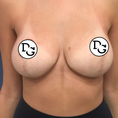Postop Breast Reduction