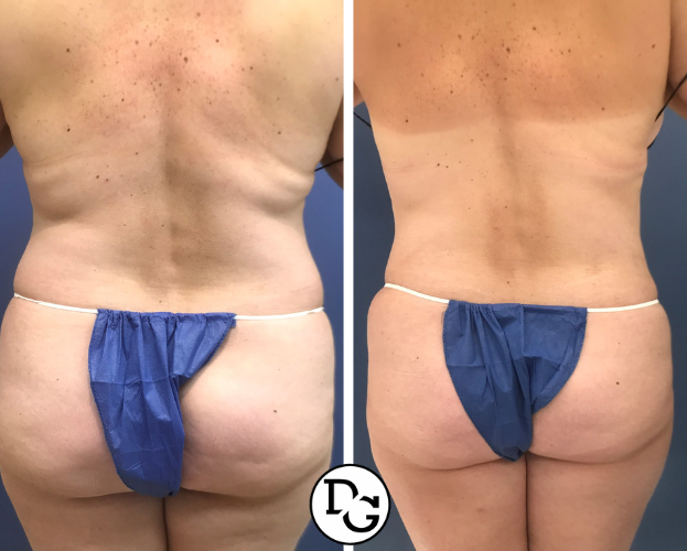Liposuction case