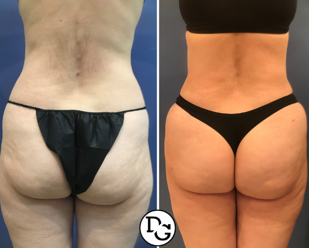 Brazilian butt lift case