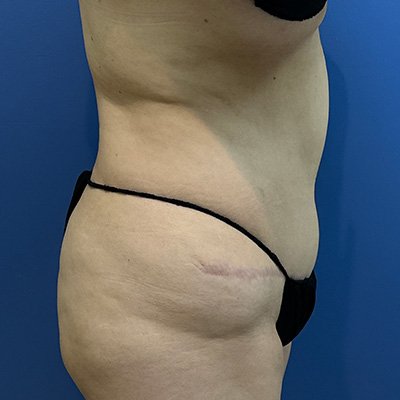 Preop Liposuction