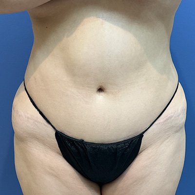 Preop Liposuction